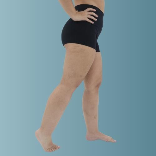 Dr. David Mognato - Lipedema cards