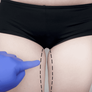 Cruroplastia com Resultados Naturais