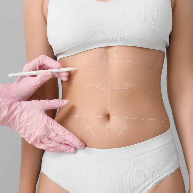 Abdominoplastia: Como Conquistar Resultados Naturais e Harmônicos