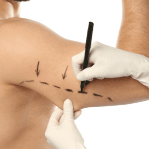 Braquioplastia Dr. David Mognato: Transformação para Braços Mais Firmes